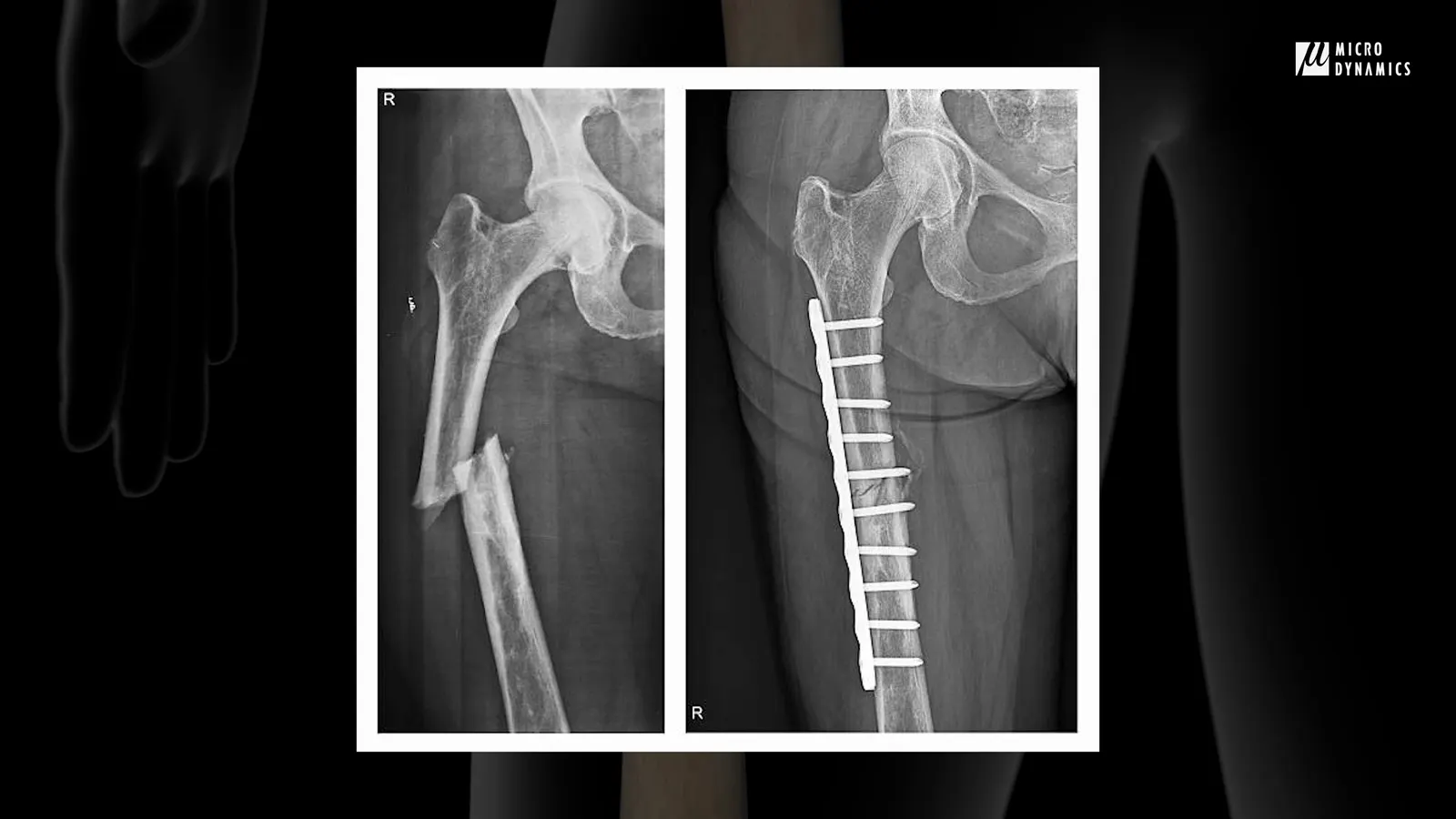 How To Machine An Orthopedic Bone Plate: Complete Process in One Cycle